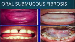 Oral Submucous Fibrosis OSMF  Premalignant Lesion I Dental Guide I Dr Bimal Chand I [upl. by Hodge141]