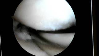 Dr Robert Eppley Arthroscopic Knee Surgery Video  3 [upl. by Killam]