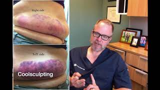 Sculpsure vs Coolsculpting  Which One is Better [upl. by Naara8]