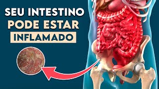 INTESTINO INFLAMADO Sintomas de Doença Inflamatória Intestinal │ Doença de Crohn [upl. by Attenohs]