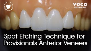 Spot Etching Technique for Provisionals Anterior Veneers Temporary Veneers ǀ Structur 3  VOCO GmbH [upl. by Ahsinahs]