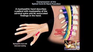 Compression of the Spinal Cord amp Hand Function  Everything You Need To Know  Dr Nabil Ebraheim [upl. by Enirhtak]