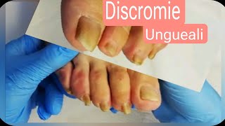 Unghie ispessite tutorial step by step Pedicure di anziani e come risolvere [upl. by Honebein168]