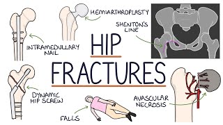 Understanding Hip Fractures and Hip Surgery [upl. by Aremat428]