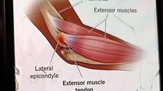 Lateral Epicondylitis Tennis Elbow treatment [upl. by Arnuad76]