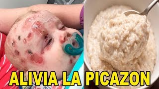 Tips Caseros para Aliviar la Comezón de la Varicela en Niños No dejes que Sufra [upl. by Nesyla]