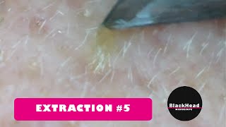 Whitehead and BlackHead RemovalExtraction 5 Reedit [upl. by Sevein571]