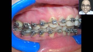 Pegado de Brackets y Tubos en las Tecnicas Individualizadas 2 [upl. by Nahtnoj]