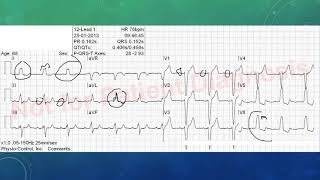 EKG befunden leicht gemacht EKG Beispiele [upl. by Andromede]