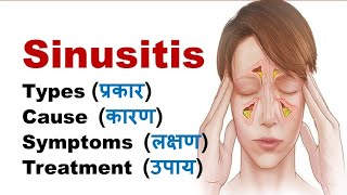 Sinusitis  Types Causes Symptoms Treatment  Sinuses [upl. by Ecirpak76]