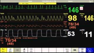 Cardiac Arrest  Patient Monitor [upl. by Harewood947]