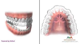 How Invisalign or Clear Aligners work  Orthodontic Treatment [upl. by Alad83]