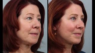 Day By Day Weekend Mini Facelift amp Blepharoplasty Recovery [upl. by Dowdell]