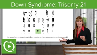 Down Syndrome Trisomy 21 – Medical Genetics  Lecturio [upl. by Ahsaya]