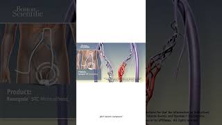 Nonsurgical treatment of Varicocele 3D animation  Varicocele embolization  by Dr Gaurav G [upl. by Onidranreb]