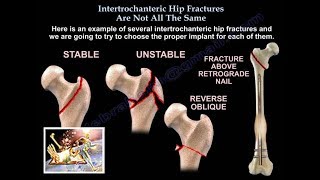 Intertrochanteric Hip Fractures  not the Same  Everything You Need To Know  Dr Nabil Ebraheim [upl. by Groeg]