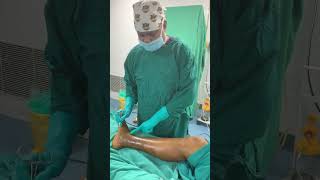 How LASER is used to treat varicose vein [upl. by Becht]