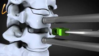 Hernie discale cervicale  Spinal disk herniation  Kisco International [upl. by Ydniw]