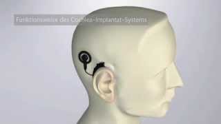 Funktionsweise des cochleaimplantatsystem [upl. by Hannahsohs656]