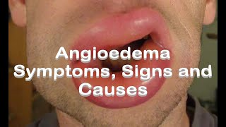 Angioedema  Symptoms Signs and Causes [upl. by Norbie134]