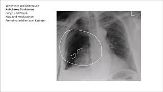 Röntgen Thorax Befundung [upl. by Meda]