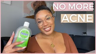 How to use Dettol to get rid of your body acne FOR GOOD  Get acne free skin with this 1 product [upl. by Uranie]