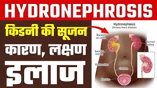 Hydronephrosis हाइड्रोनफ्रोसिस या क‍िडनी में सूजन के कारण लक्षण और इलाज  hydronephrosis treatment [upl. by Attevad]