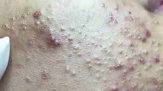 Blackheads amp Whiteheads Satisfying Removal 0053 [upl. by Eelhsa]