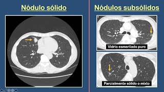 Nódulo Pulmonar Solitario [upl. by Ymij106]