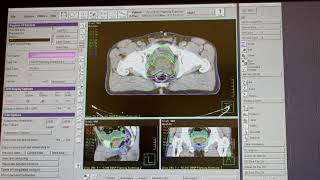 Radiotherapy Planning [upl. by Charmain224]