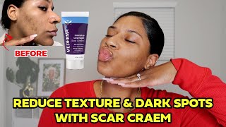 Mederma Cream for Acne Scars  My 2 Week Transformation [upl. by Yate]