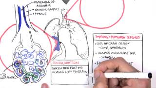 PART I  Pneumonia Overview Lobar and Bronchopneumonia [upl. by Ming]