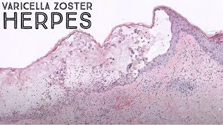 Shingles under the microscope Varicella Zoster Herpes virus Chickenpox VZV pathology dermatology [upl. by Anelys]