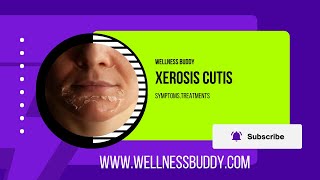 Xerosis Cutis Severe Dry Skin Calluses and Fissures [upl. by Virg]