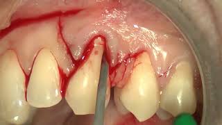 9 Multiple bilaminar technique with single vertical releasing incision in the upper jaw [upl. by Karab350]