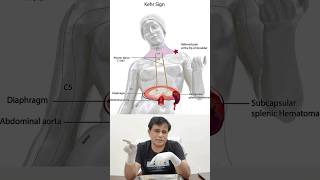 What is Kehr’s Sign Infarction of spleen splenic rupture shorts clinicalanatomyofspleen [upl. by Zanahs]