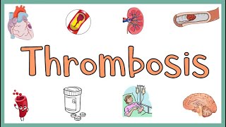 Thrombosis  Definition Causes Types Morphology Fate of a Thrombus amp Clinical manifestations [upl. by Carolyne]