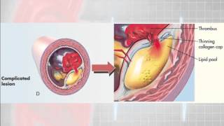 12 Lead Interpretation Part 61 Pathophysiolgoy of Myocardial Infarctions [upl. by Nodab833]