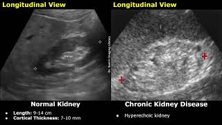 Kidney Ultrasound Normal Vs Chronic Kidney Disease CKD Imaging Findings  Chronic Renal Failure [upl. by Eimyaj530]