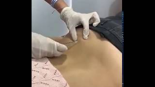 TERAPIA NEURAL PARA MANEJO DEL DOLOR EN SACROILEITIS [upl. by Miguela]