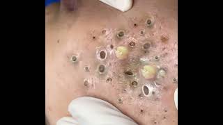 Big Cystic Acne Blackheads Extraction Blackheads amp Milia Whiteheads Removal Pimple Popping 0203 [upl. by Volin]