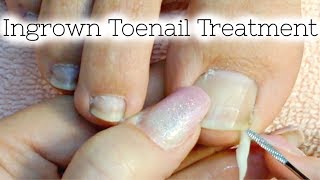 Pedicure Tutorial Ingrown Toenail Treatment At Home How to Recut Nail Groove to Eliminate Pain [upl. by Nored]