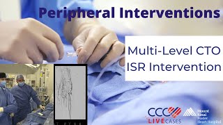 MultiLevel CTO ISR Intervention [upl. by Annairdna]