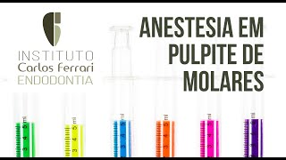 Anestesia em pulpite de molares [upl. by Ainesey]