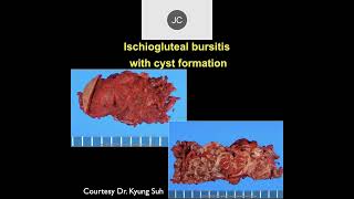 MRI of the Hip Part 10 – Hip Inflammation [upl. by Trisha]