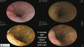 Early Detection of Esophageal Cancer and Barrett’s Esophagus Recent Advances [upl. by Eyllek]