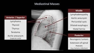 How to Interpret a Chest XRay Lesson 5  Cardiac Silhouette and Mediastinum [upl. by Brody]