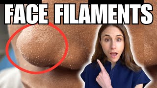 Sebaceous Filaments Vs Demodex Face Mites [upl. by Myrta589]