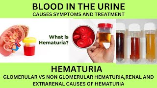 BLOOD IN THE URINEHEMATURIACAUSES SYMPTOMS DIAGNOSIS AND TREATMENT OF BLOOD IN THE URINE [upl. by Marilla]