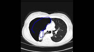 Pneumothorax due to lymphangioleiomyomatosis [upl. by Lira]